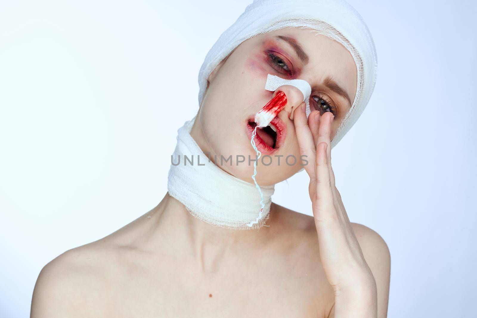woman bruised face medicine treatment injury accident light background. High quality photo