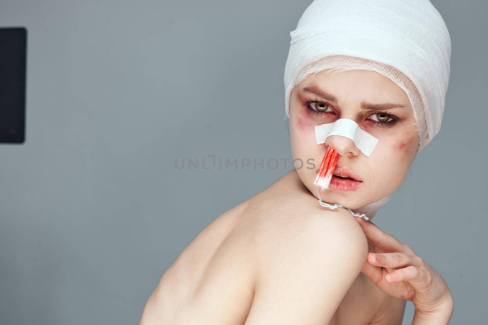 female patient tampon in the nose with blood injured face close-up. High quality photo