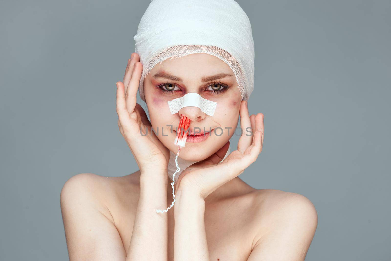 woman bruised face medicine treatment injury accident light background. High quality photo