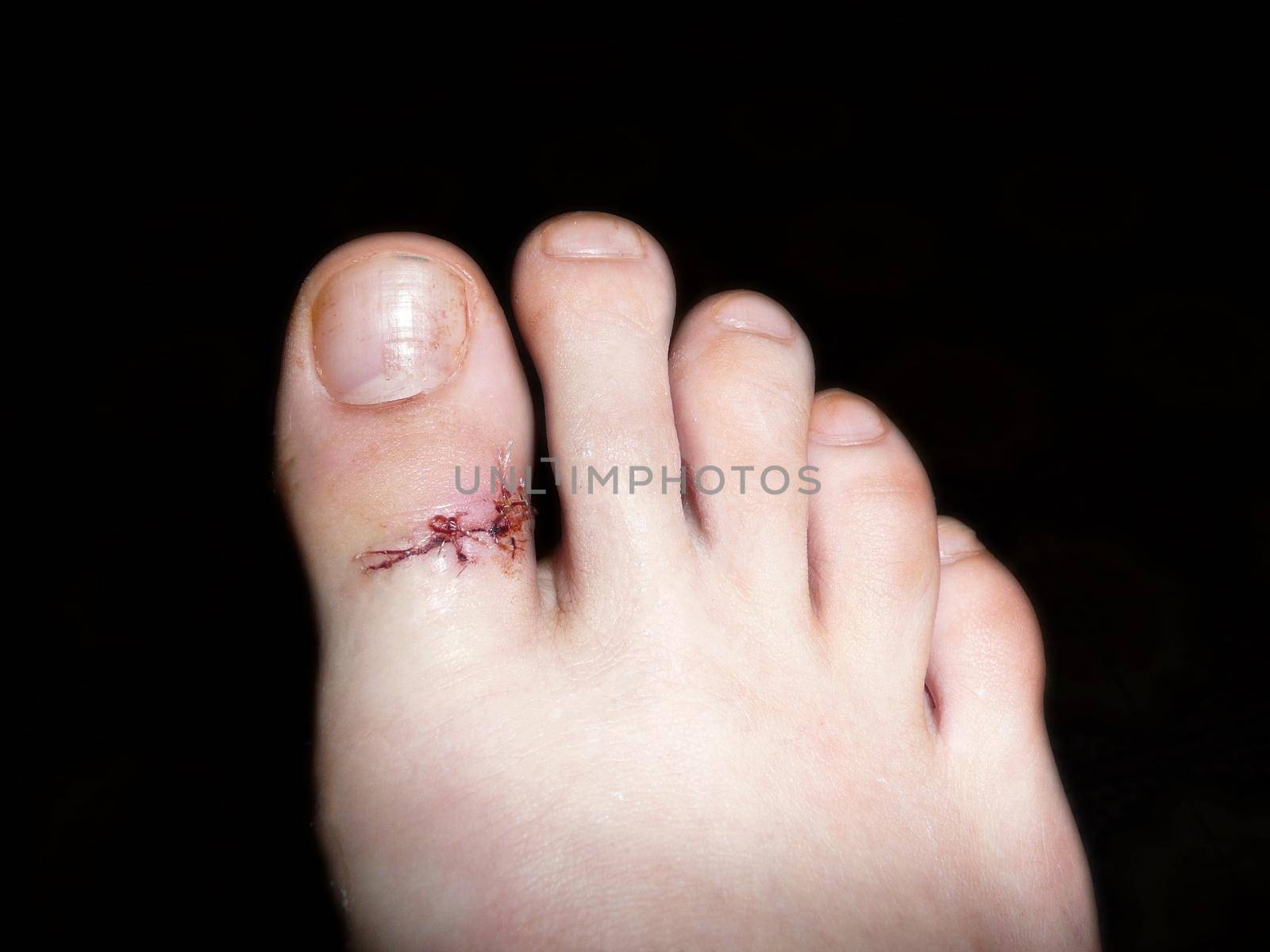 surgical suture on the big toe after injury isolated on black background.