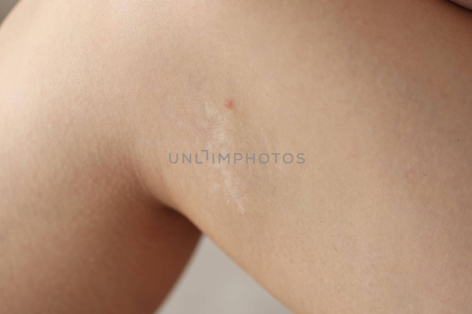 An inflamed pimple on the leg, close-up, shugaring. Skin irritation, dermatologist visit, problem skin