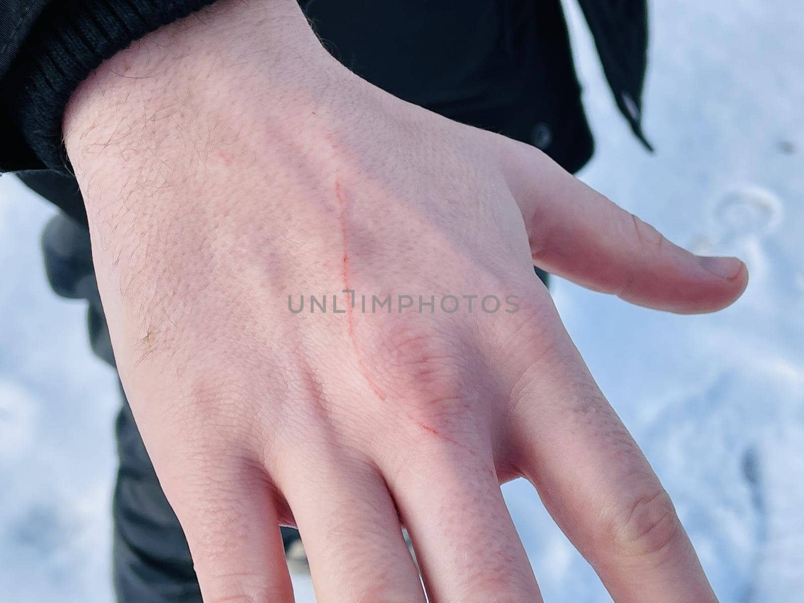 scratch on a hand, close up by epidemiks