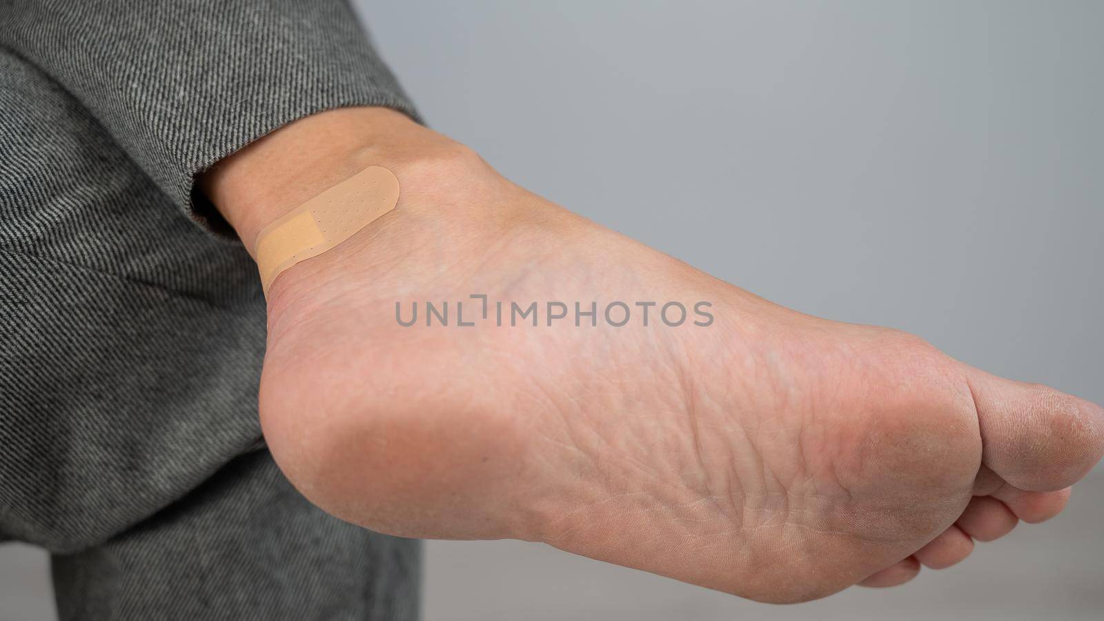 A woman seals a corn on her leg with a plaster. The girl rubbed her leg with uncomfortable shoes. by mrwed54