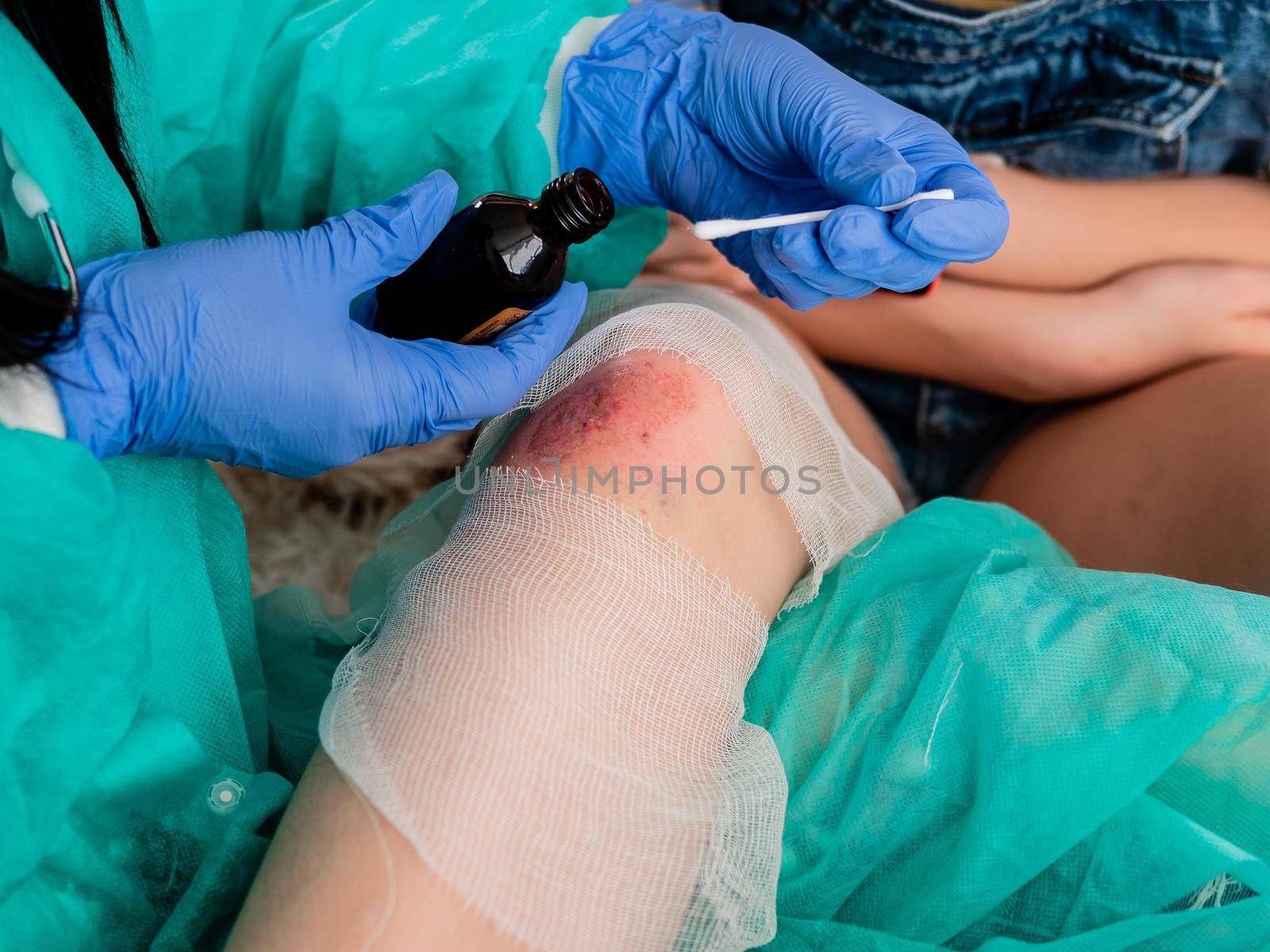 A female doctor in sterile gloves treats a wound on the knee of a teenage girl with iodine.