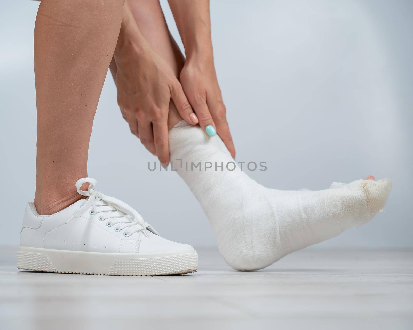 Close-up of female legs with plaster cast. A woman with a broken leg sits on a chair by mrwed54