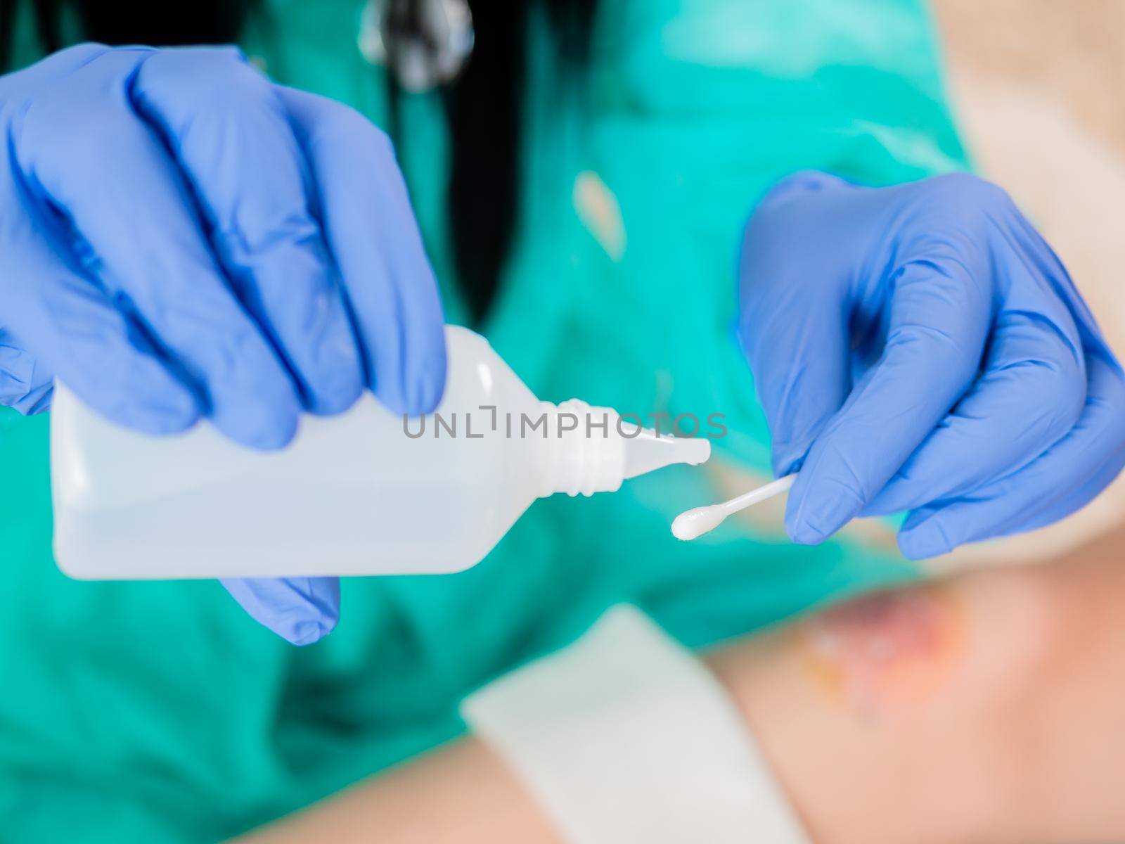 Close-up of a cotton swab and a bottle of antiseptic in the hands of a doctor, against the background of a wound on the patient's leg.