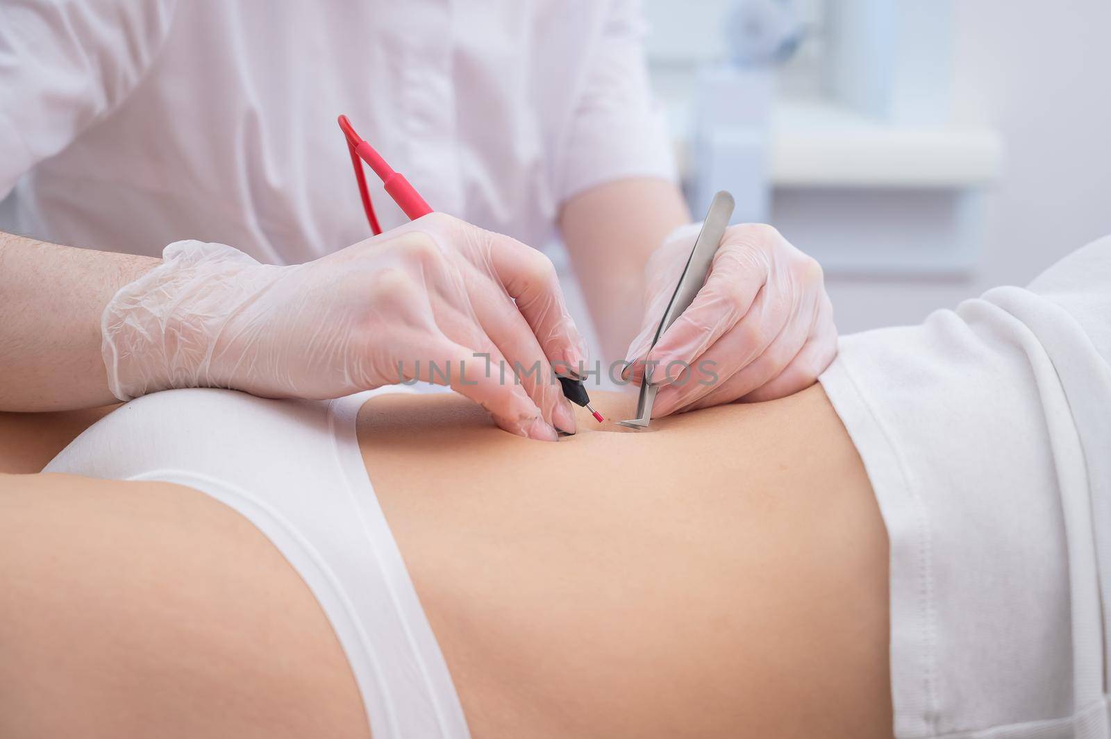 Woman on electro epilation on her tummy. Permanent hardware removal of unwanted abdominal hair