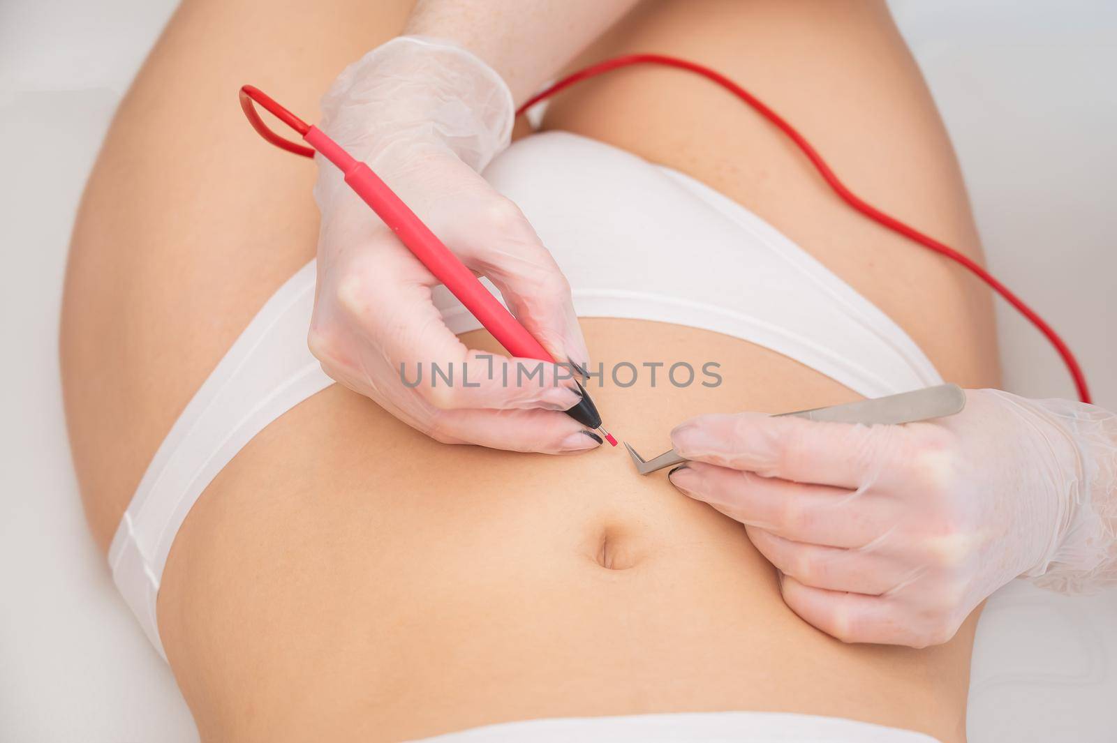 Woman on electro epilation on her tummy. Permanent hardware removal of unwanted abdominal hair