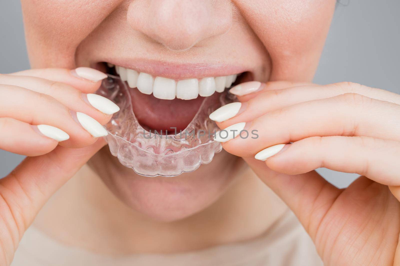 Close-up portrait of a woman putting on a transparent plastic retainer. A girl corrects a bite with the help of an orthodontic device by mrwed54