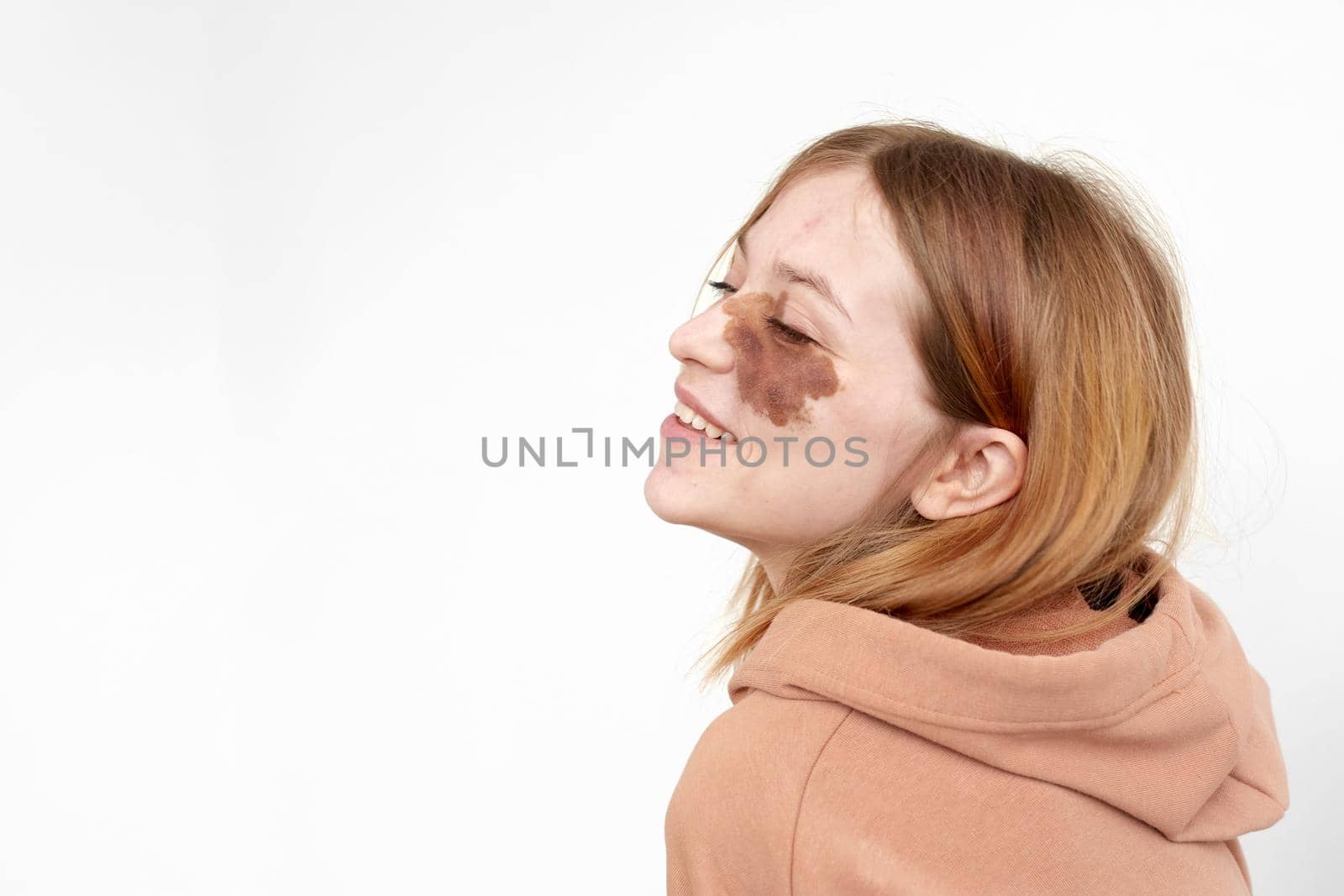 Side view of happy young lady in hoodie with brown birthmark on face with closed eyes on white background in light studio