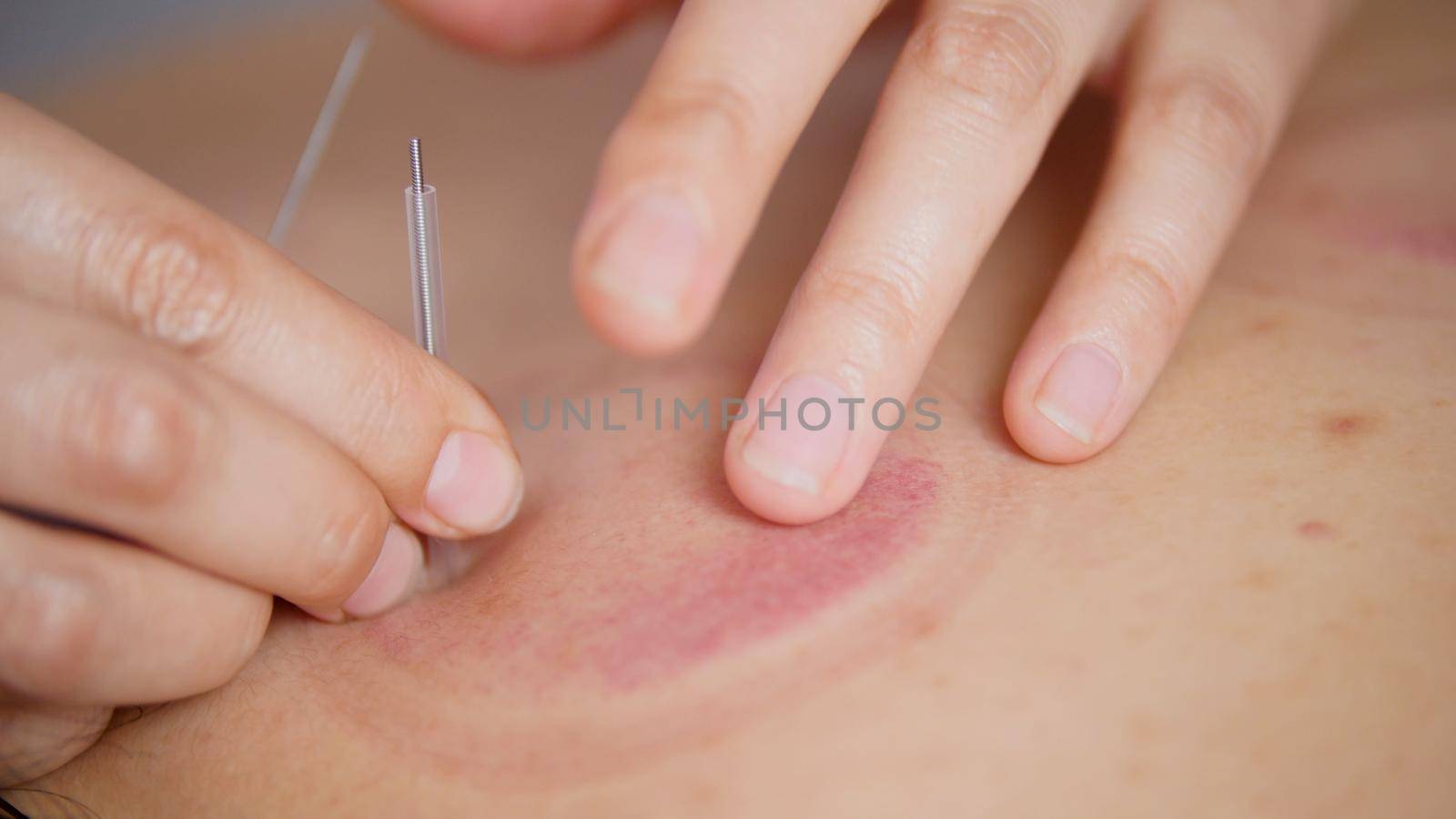 The doctor applies the acupuncture therapy on the girl's back