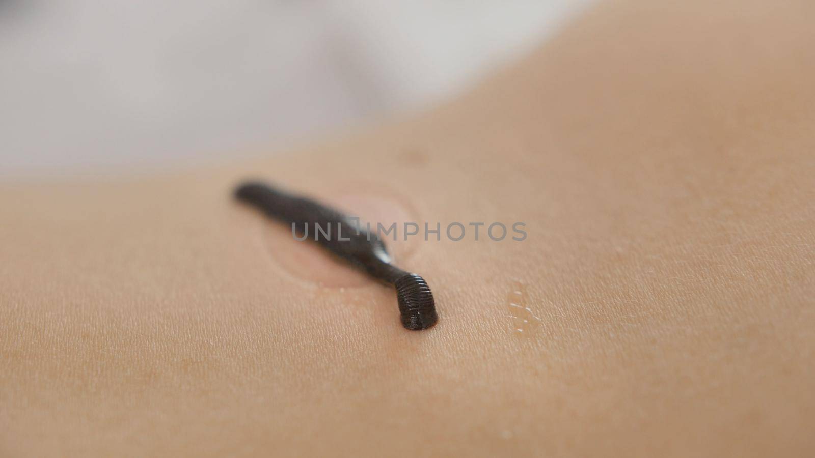 Hirudotherapy in clinic - Leech on skin of woman - close up view