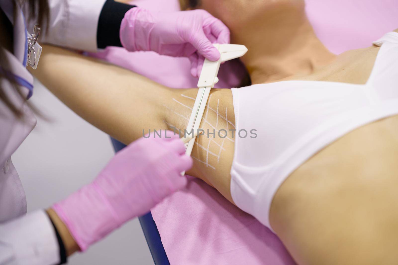 Doctor painting on the armpit of her middle-aged patient, the area to be treated for hyperhidrosis.