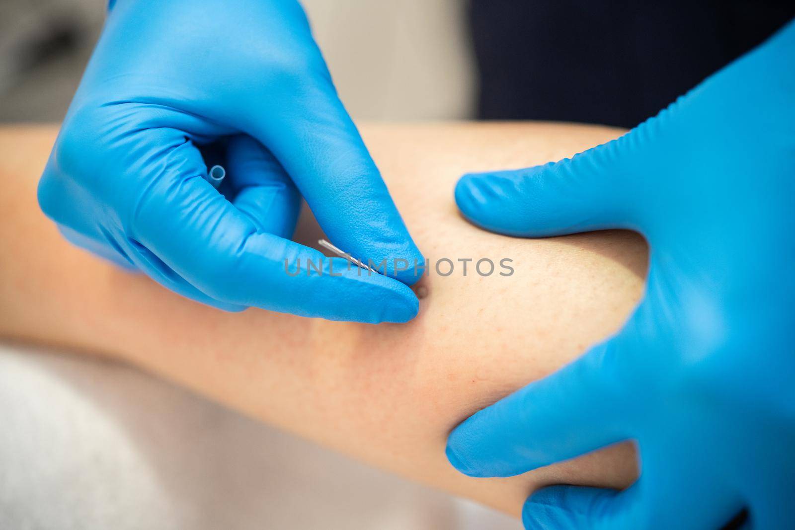 Close-up of a needle and hands of physiotherapist doing a dry needling in a physiotherapy center.