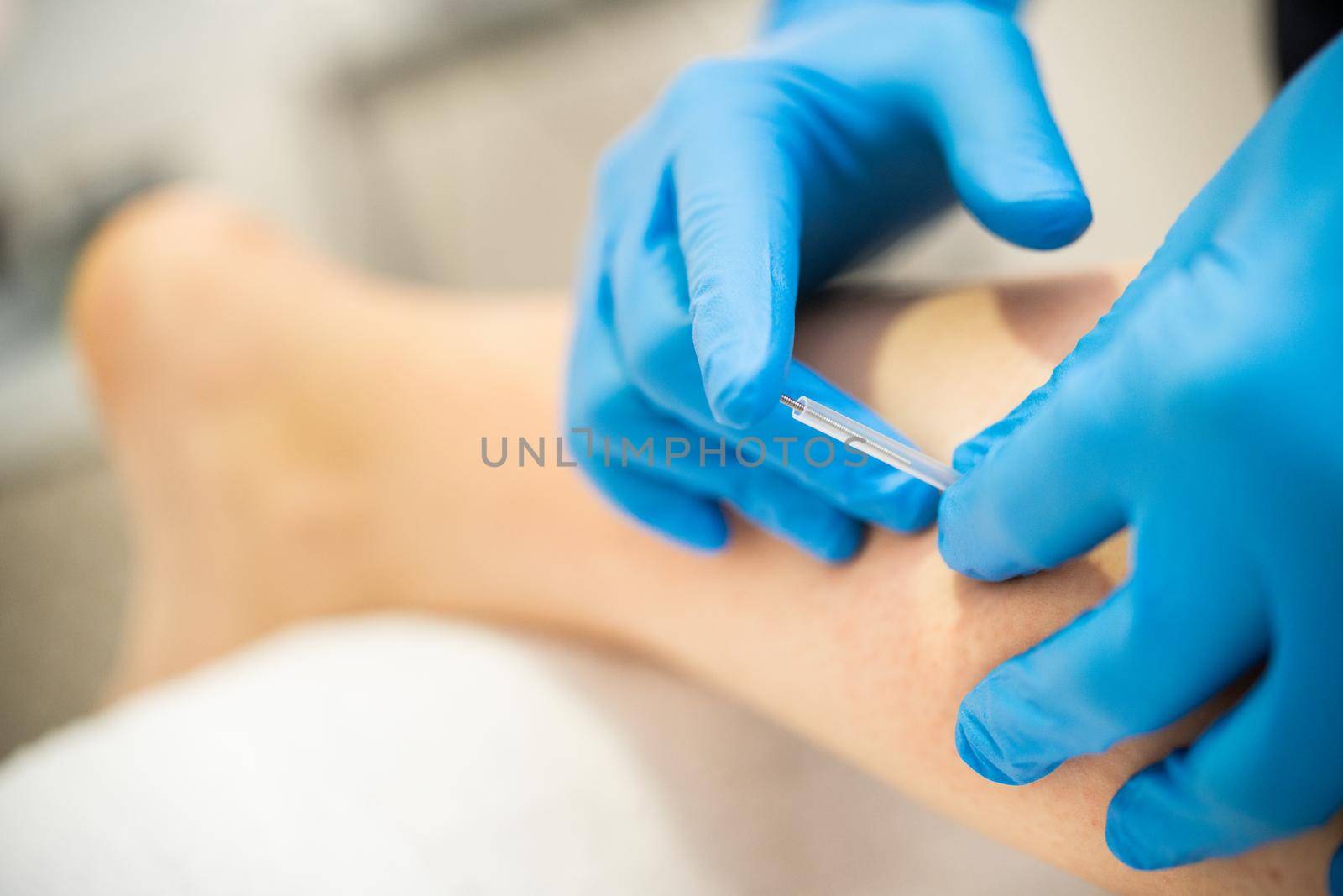 Close-up of a needle and hands of physiotherapist doing a dry needling in a physiotherapy center.