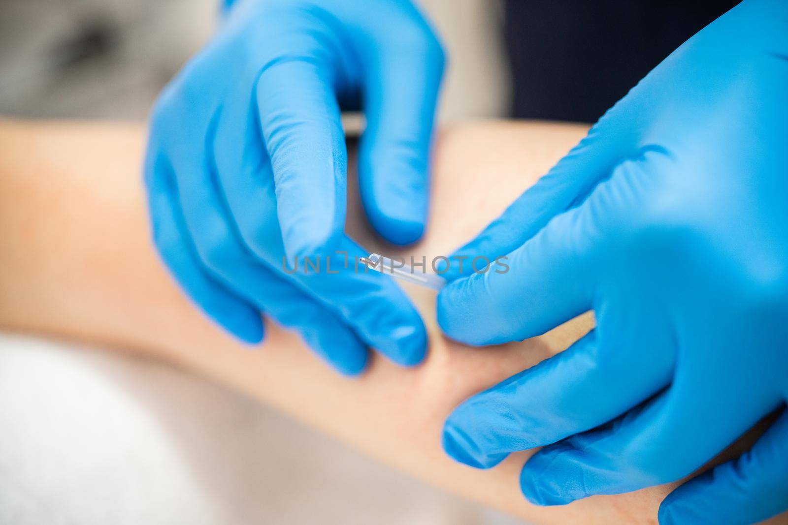 Close-up of a needle and hands of physiotherapist doing a dry needling in a physiotherapy center.