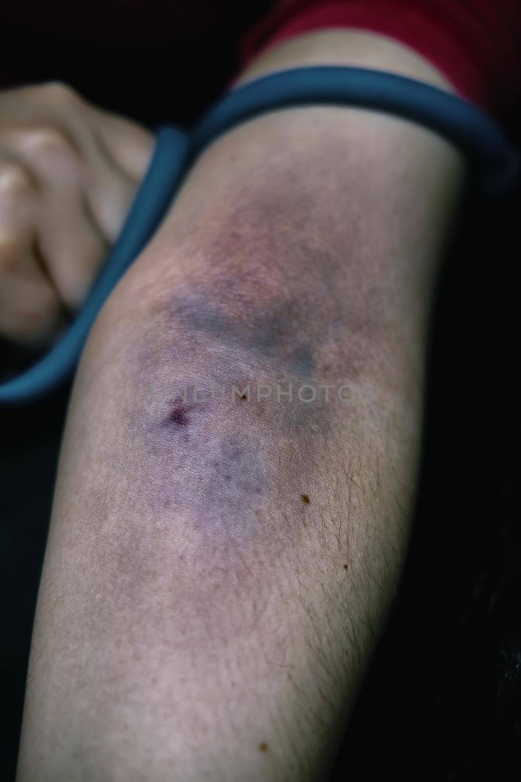 Drug addict pulls tourniquet on arm. Large blood hematoma close-up. Woman's arm is bruised from taking intravenous narcotic. Concept of despair and depression. Addiction to illegal substances.