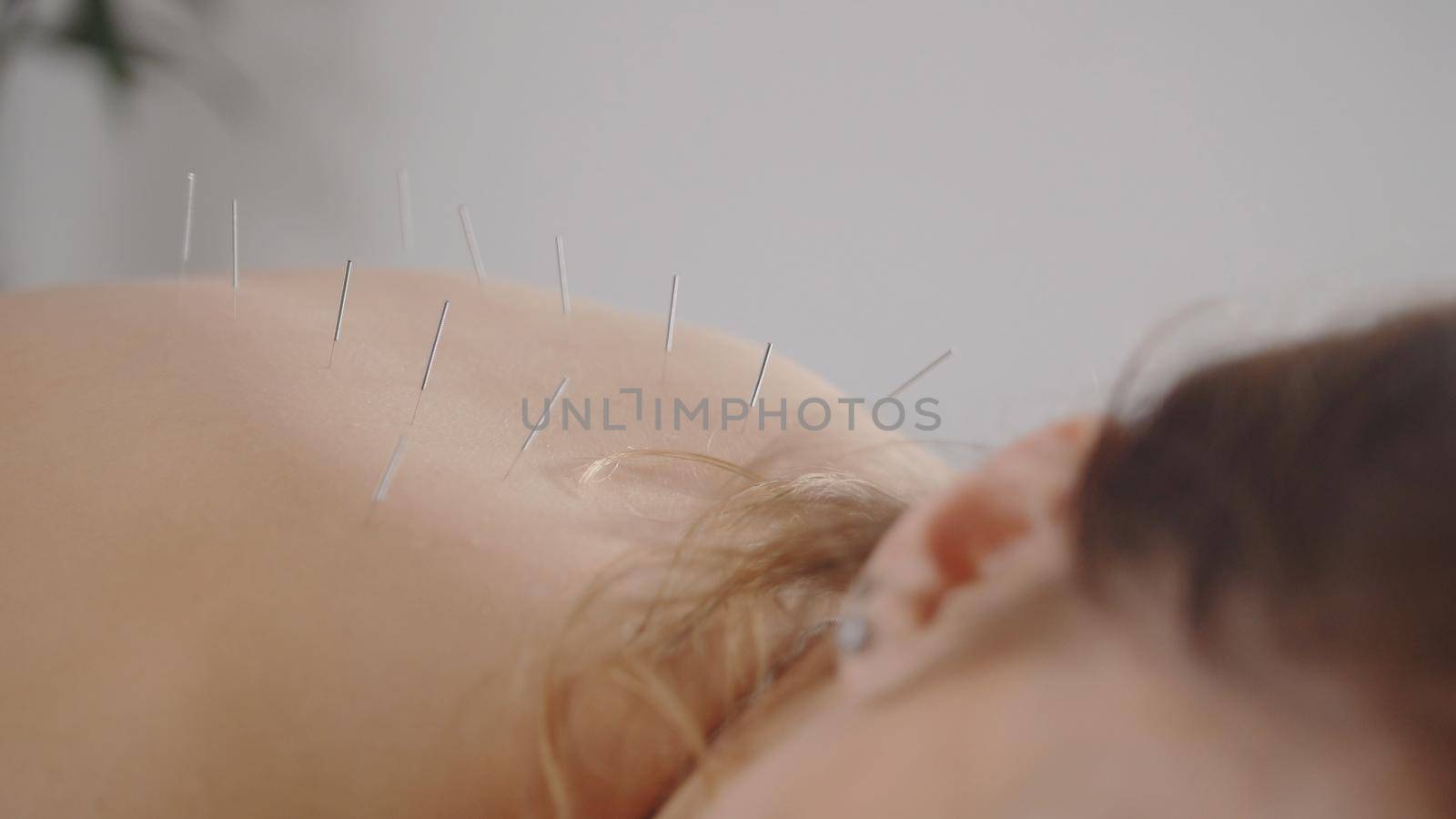 Woman's body on the acupuncture - doctor sticks needles, close up view