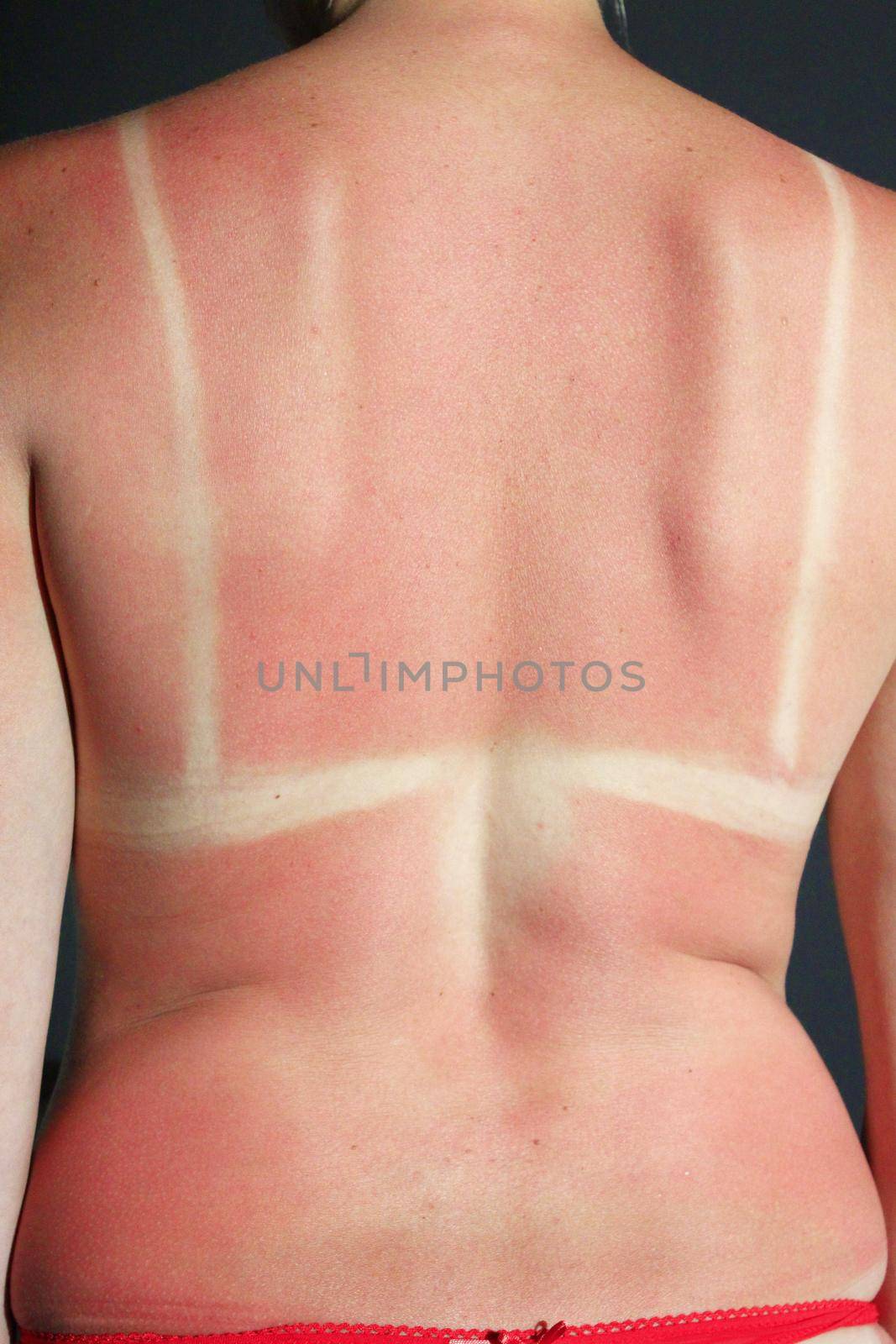 Human back burnt after sunburn. Scald of the back by sun's beams