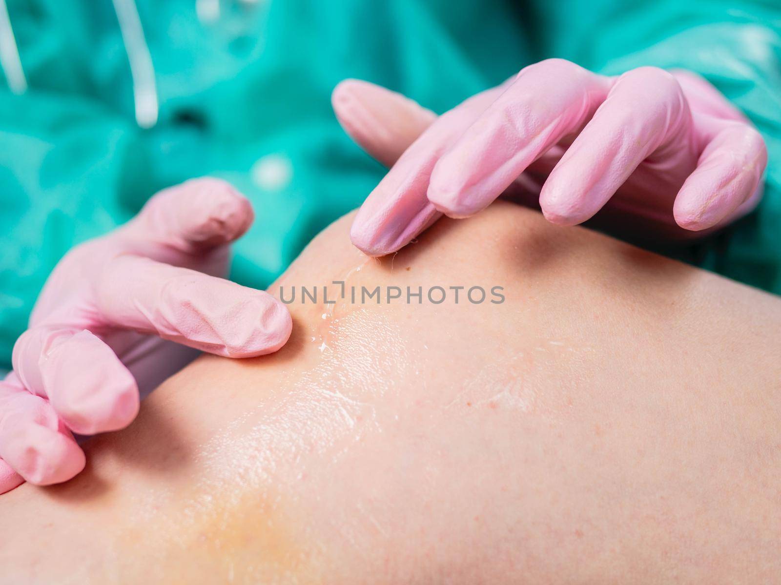 Close-up of a doctor's hand in medical gloves, rubbing cream to heal an injured knee joint. Bruise under the knee. Knee ligament injury. by Utlanov