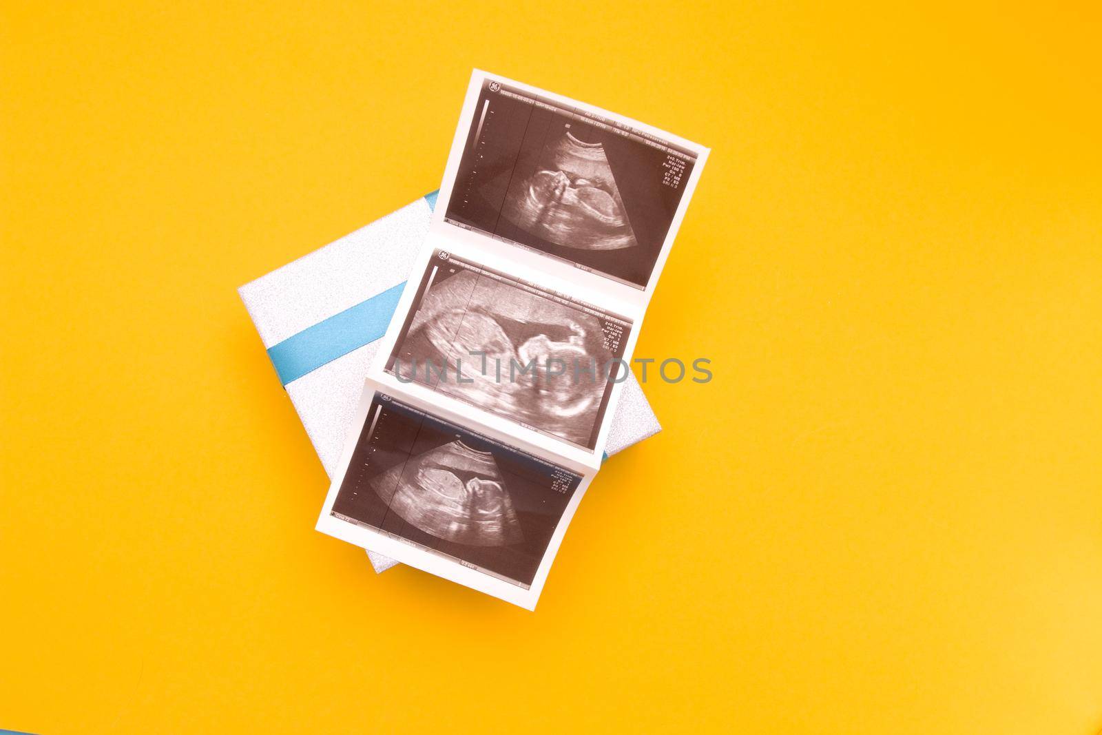 ultrasound picture in a silver box with a blue ribbon and yellow flower yellow background place copy top view, woman pregnant with boy or girl, surprise, photo as a gift, pregnancy concept by natashko