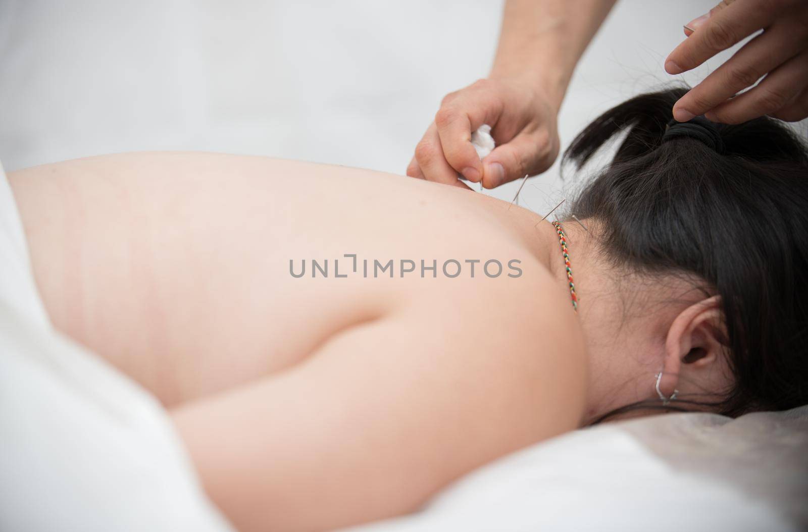 Young woman getting acupuncture treatment in therapy room. Close up shot