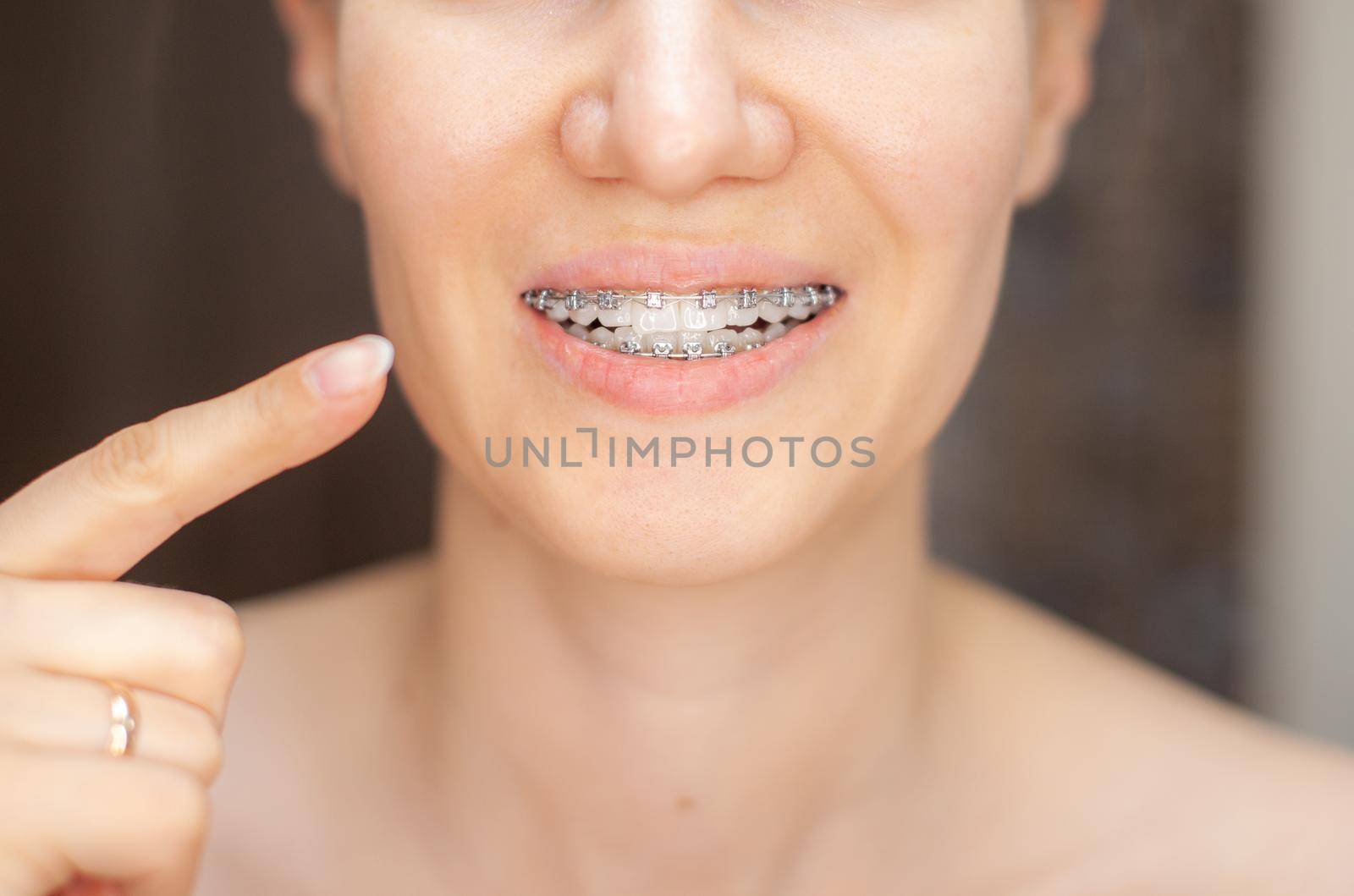 The girl points her finger at the even and white teeth with braces. by AnatoliiFoto