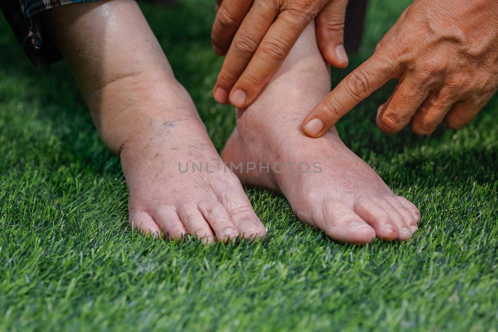 Doctor assessing a elderly swollen foot in physical therapy room