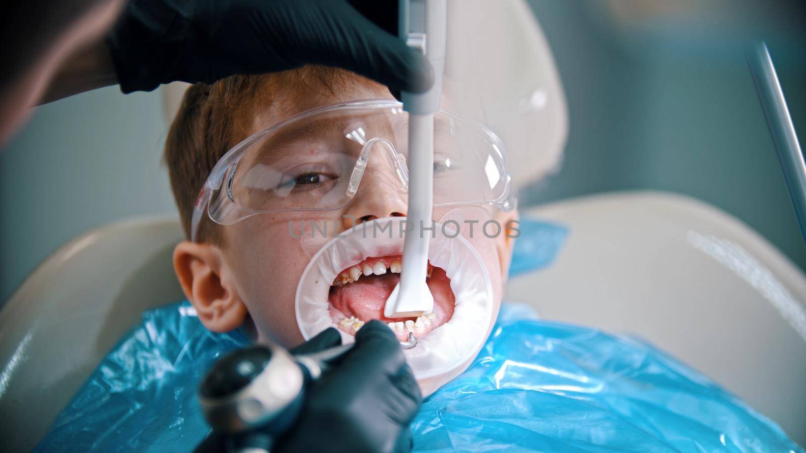 A little boy having a cleaning treatment in the dentistry. Mid shot