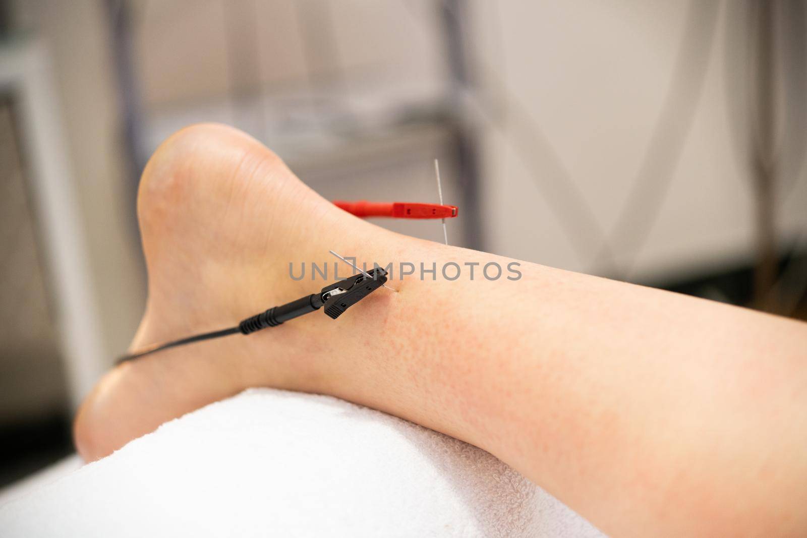 Electro-acupuncture dry with needle connecting machine. Electro stimulation in physical therapy.