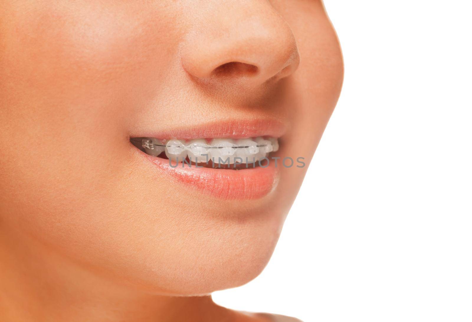 Woman smile: teeth with braces, dental care concept, side view