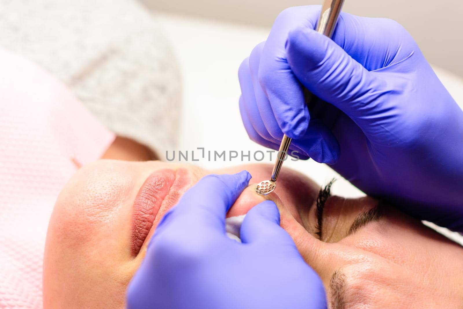 Beautician using a mechanical tool with a spoon to remove uno and clean acne on the patient's face in a beauty salon, facial care. by Niko_Cingaryuk