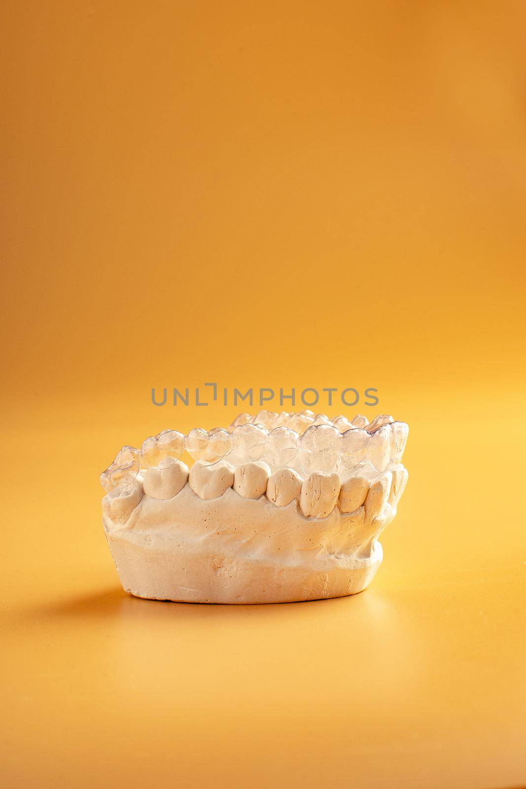Inivisalign braces or aligner. A way to have a beautiful smile and white teeth.Invisible Invisalign plastic dental teeth brackets by Maximusnd