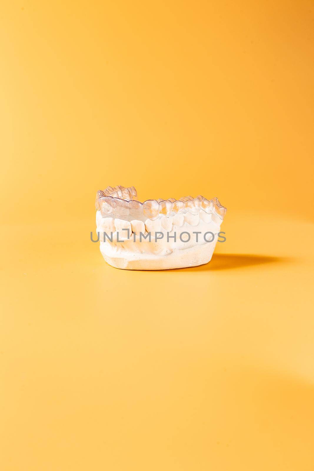 Close-up individual tooth tray Orthodontic dental theme. In hand Invisible braces by Maximusnd