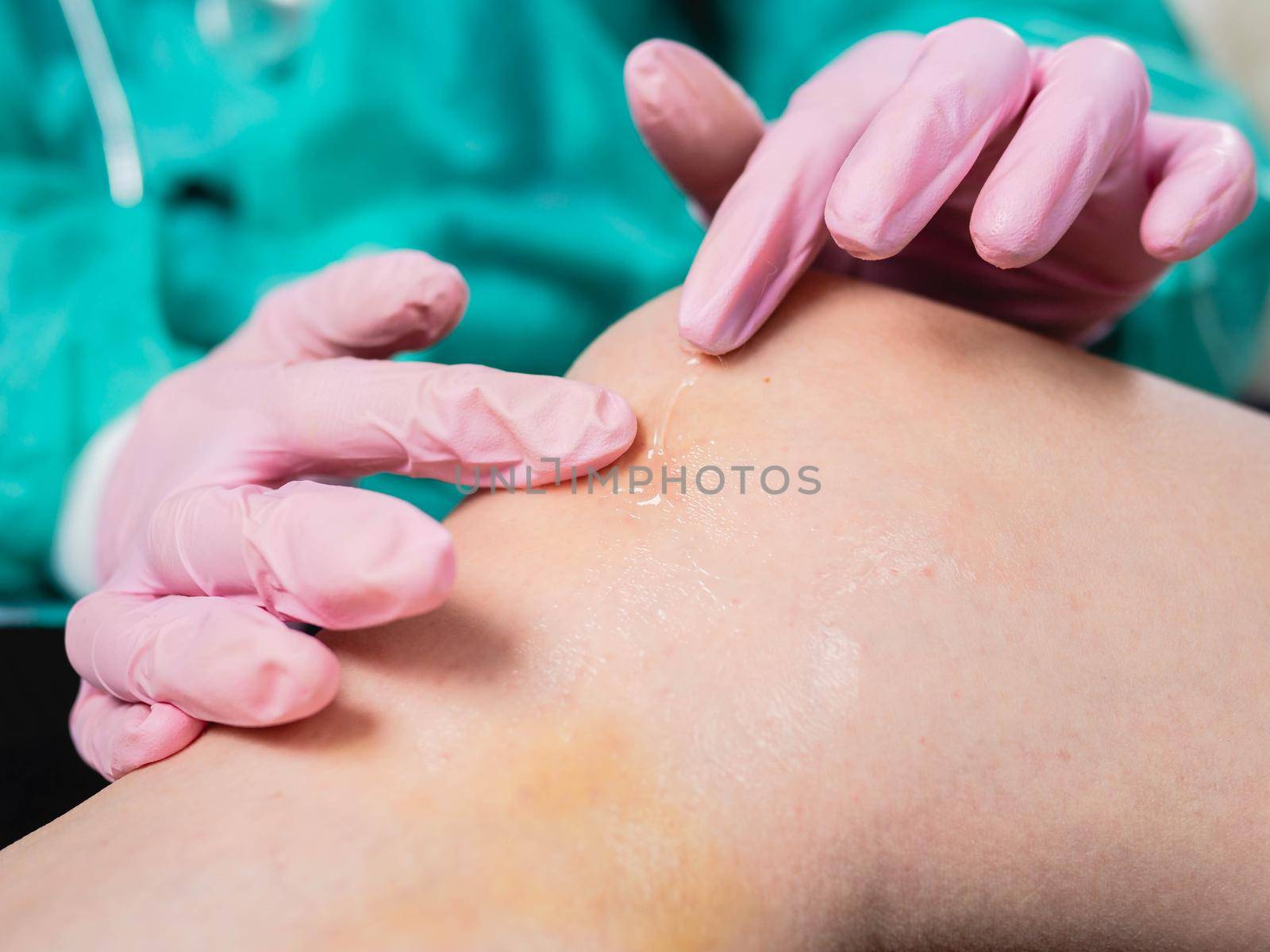 Doctor's hands apply medicinal ointment to the bruise on the patient's leg. Pain, hematoma, first aid for knee trauma.