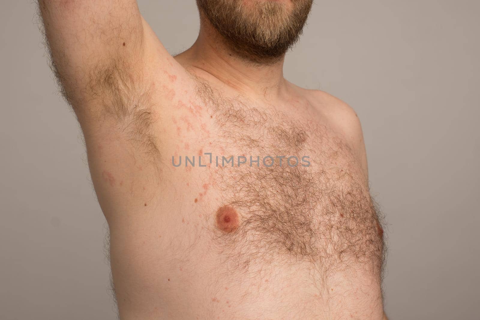Allergy reaction is red spots on the body of a young man. Urticaria