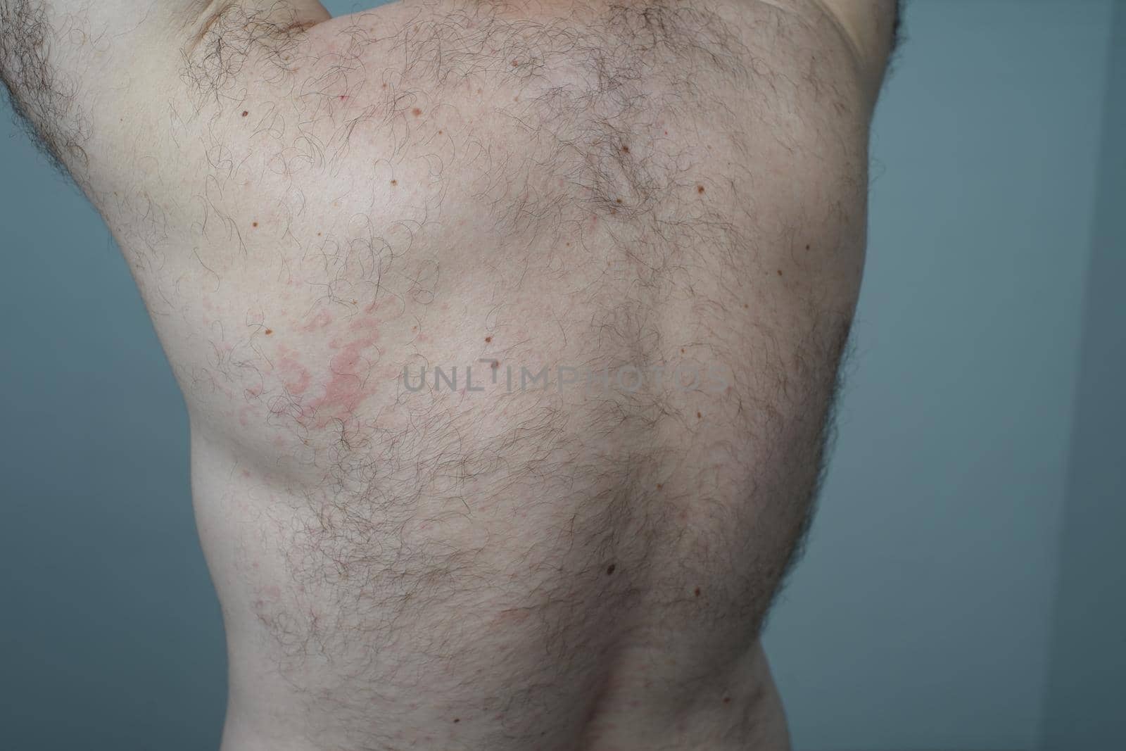 Allergy reaction is red spots on the body of a young man. Urticaria