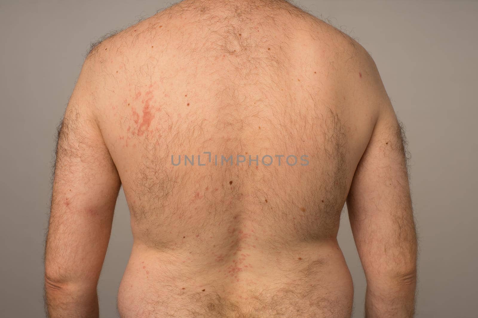 Allergy reaction is red spots on the body of a young man. Urticaria