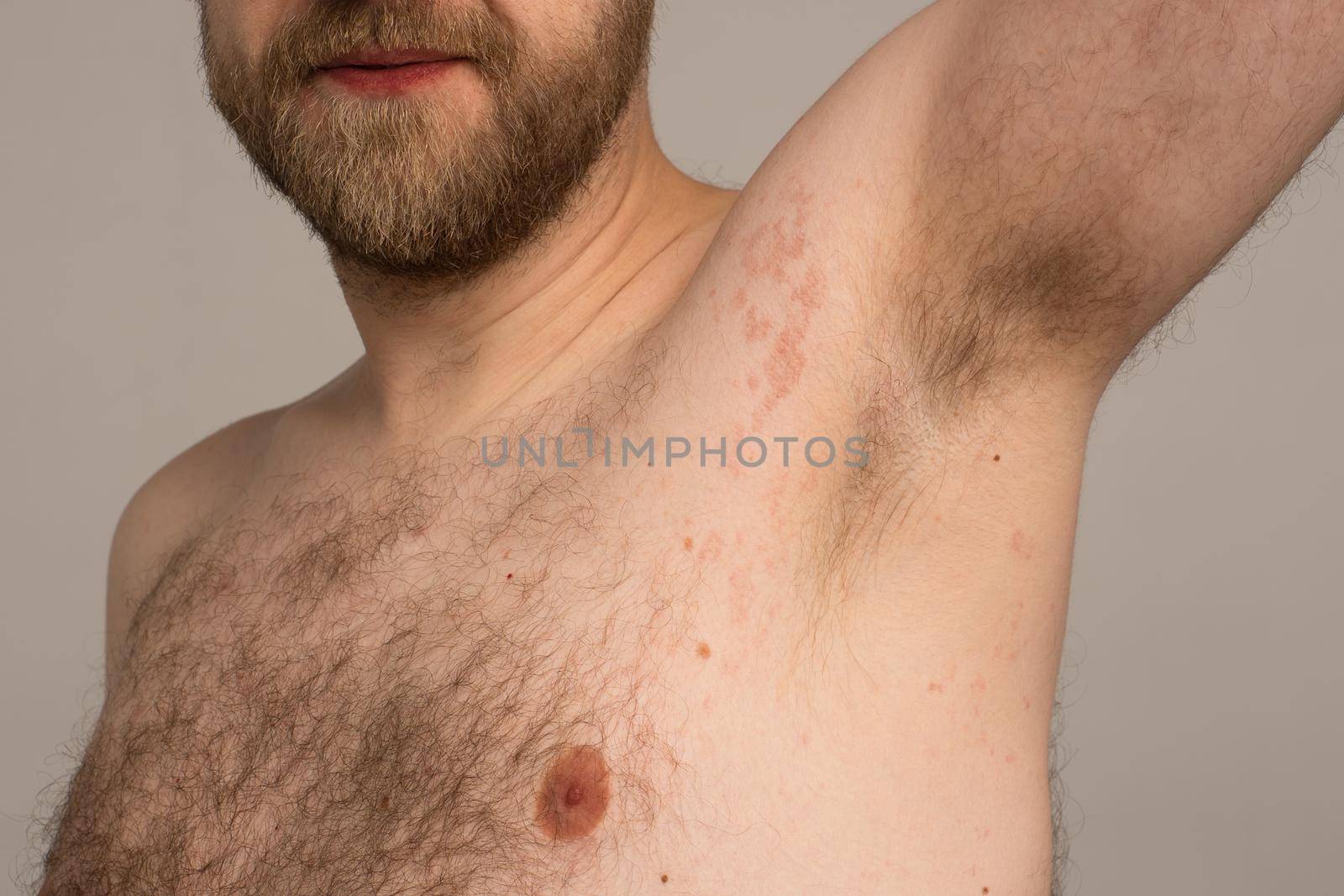 Allergy reaction is red spots on the body of a young man. Urticaria