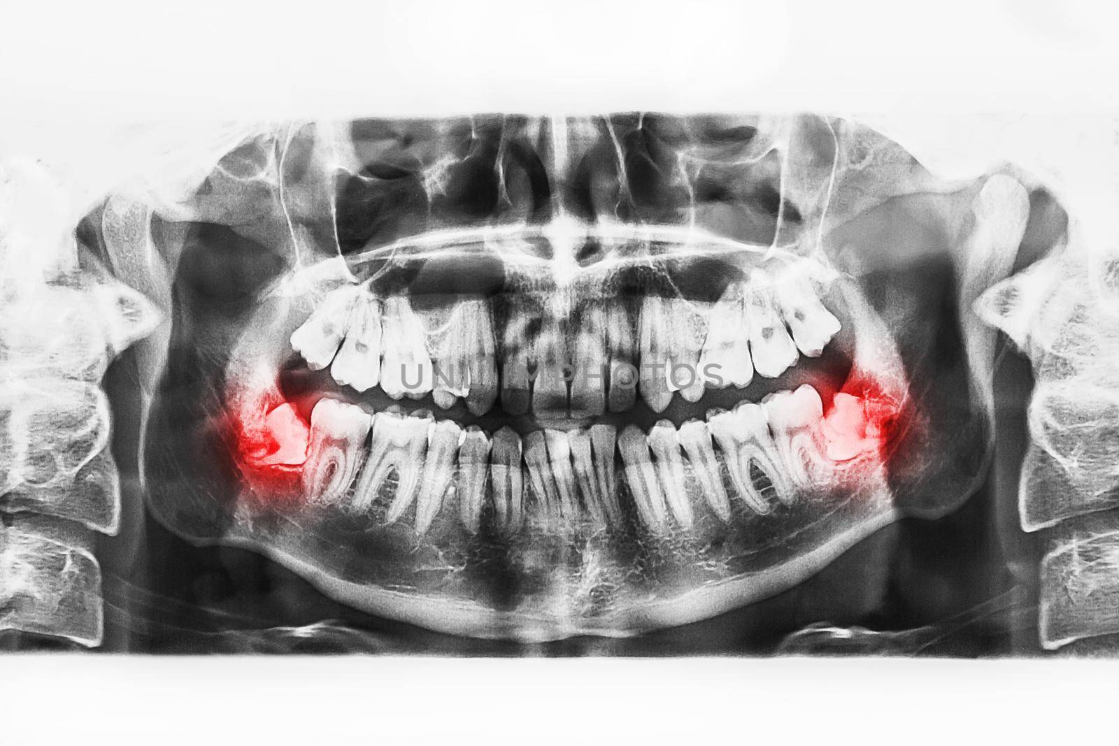 X-ray image of oral cavity with growing lower wisdom teeth on white background.