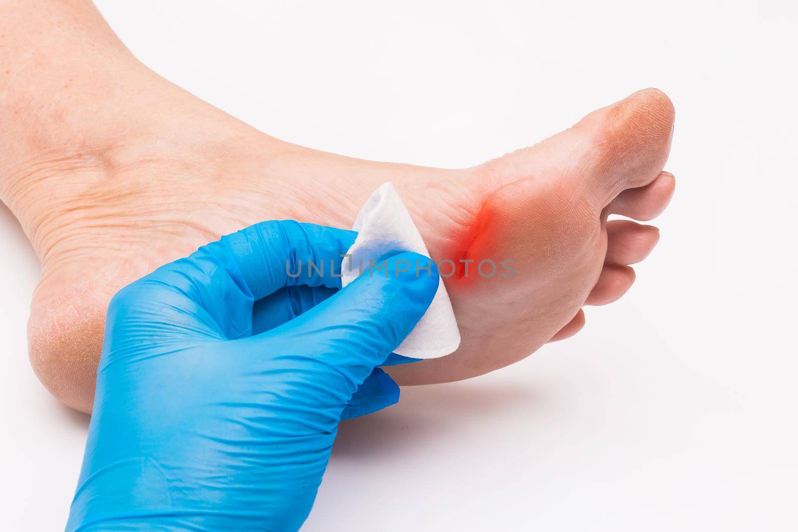Doctor's hand in a protective medical glove applies a cotton pad to the wound on the foot, woman's leg on a white background, close-up.
