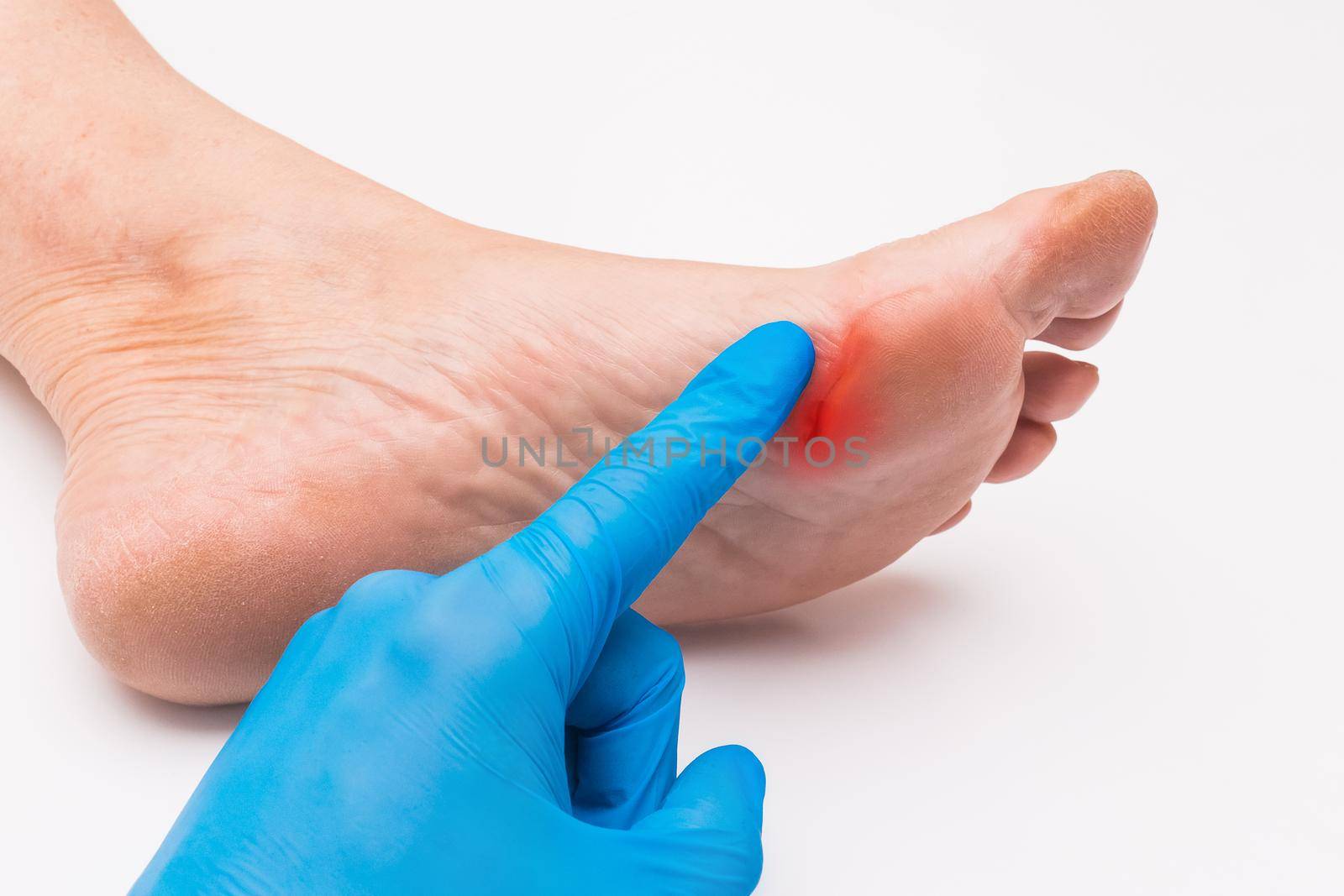 A doctor's hand in a protective medical glove touches his hand with a finger and examines the wound on the foot of an elderly woman on a white background. Medical concept.