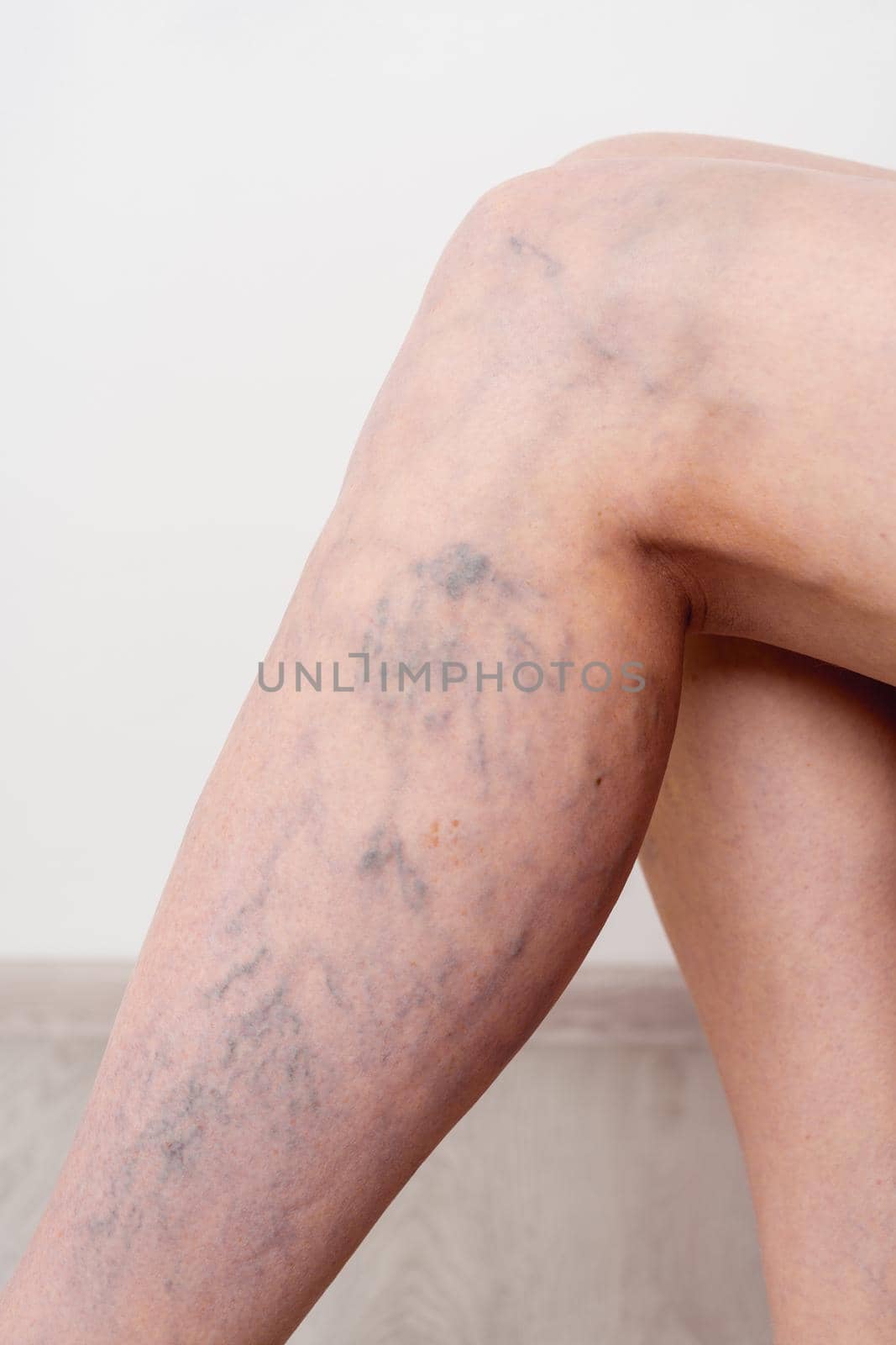 Varicose veins on a slim female legs. Phlebology - image