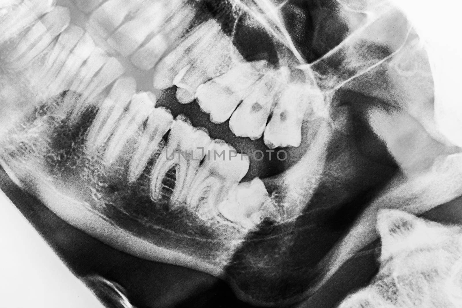 X-ray scan picture of wisdom teeth dentistry close-up.