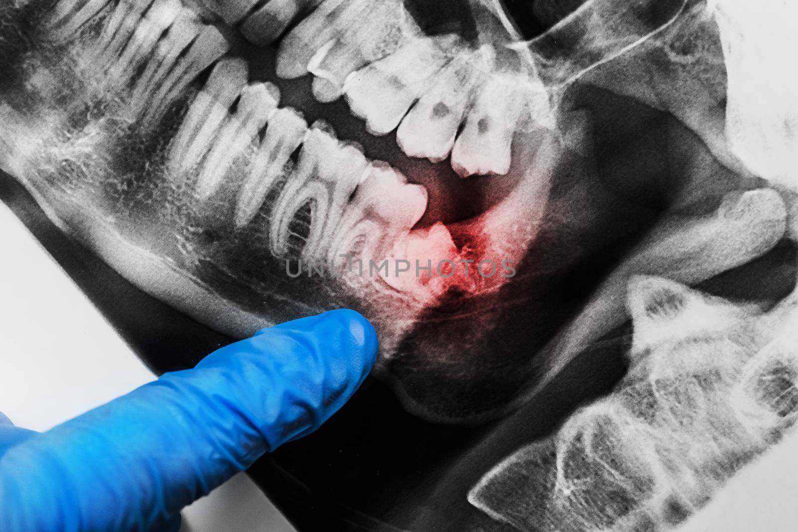 A doctor's hand in a protective medical glove points with a finger at the growth of wisdom teeth in the lower jaw on an X-ray image of the oral cavity, close-up by AYDO8