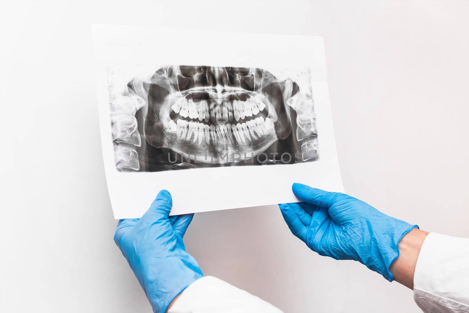 Doctor's hands in protective medical gloves are holding and examining an x-ray picture of teeth on a white background.