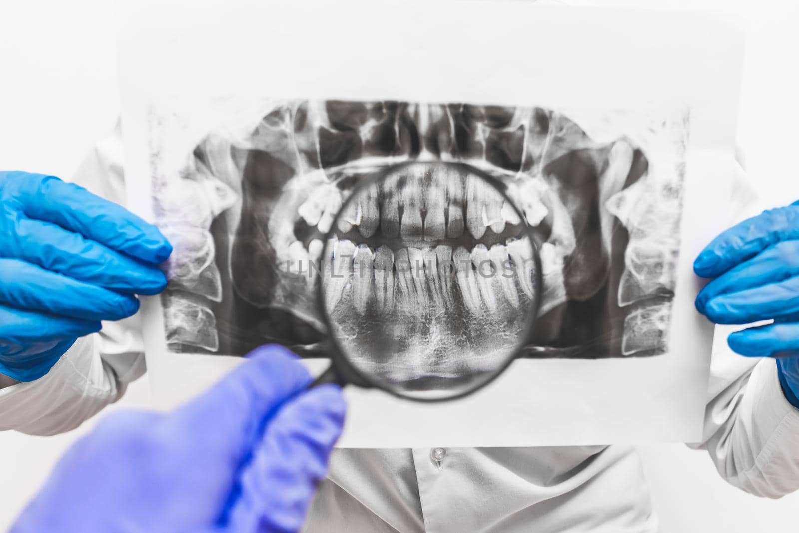 Hands of a man and a woman doctor in protective medical gloves hold and study an x-ray picture of teeth using a magnifying glass.