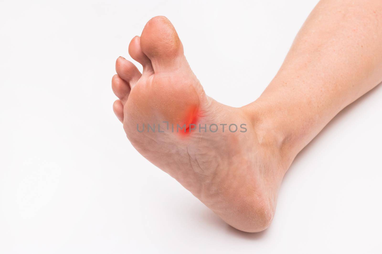 Wound on the foot, leg of an elderly woman on a white background.