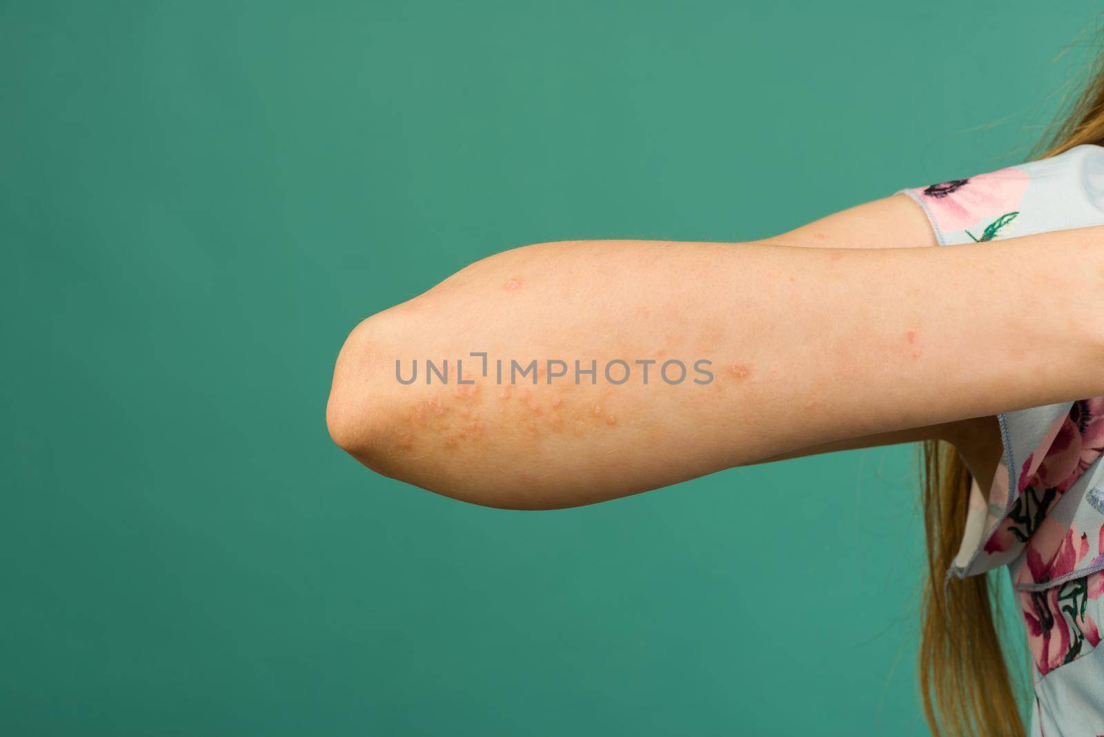 CLOSE UP: Unrecognizable young woman suffering from autoimmune incurable dermatological skin disease called psoriasis. Red, inflamed, scaly rash on elbows. Psoriatic arthritis