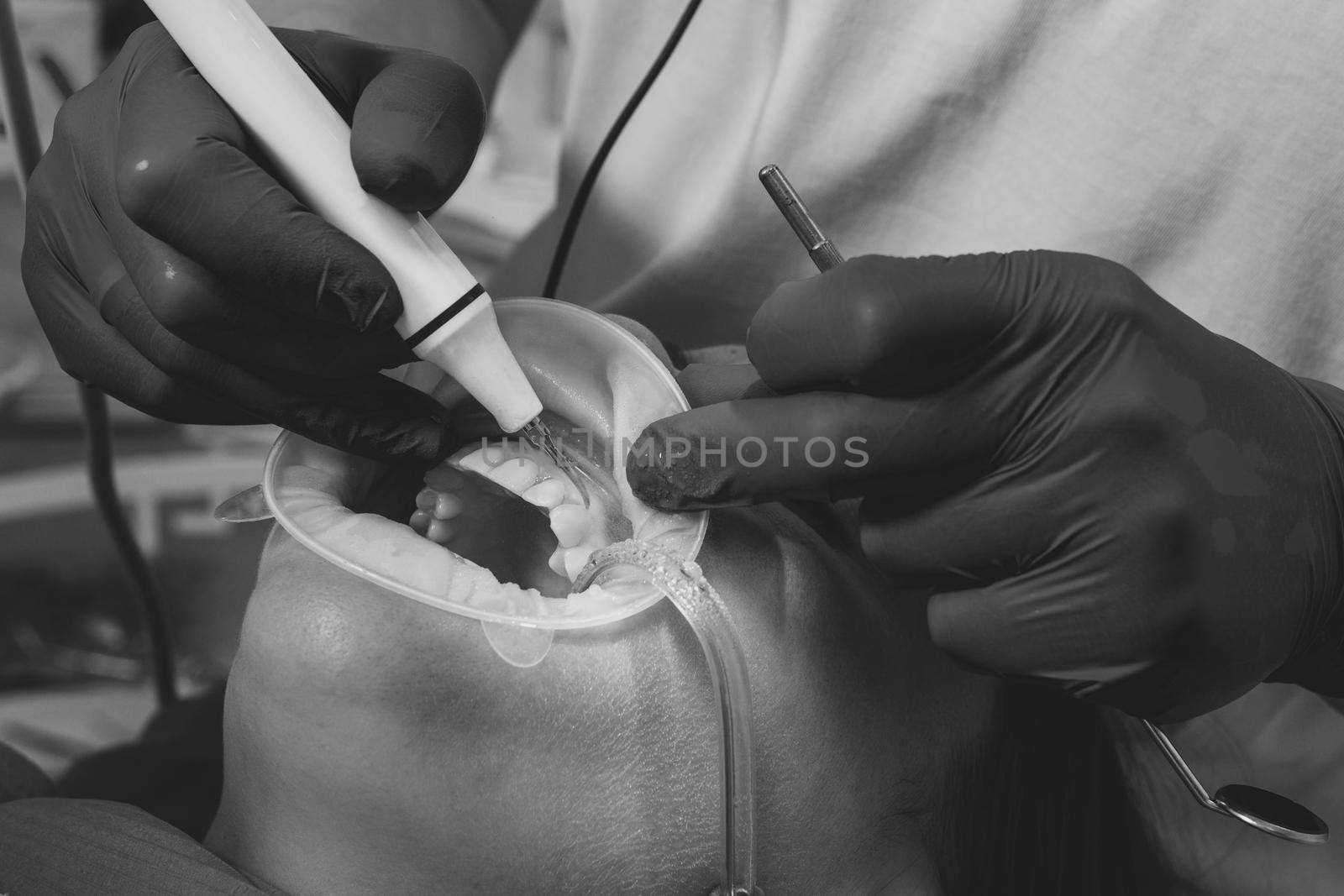 The dentist removes tartar using ultrasound, the patient at the dentist. Retractor for isolation of lips and gums. 2020
